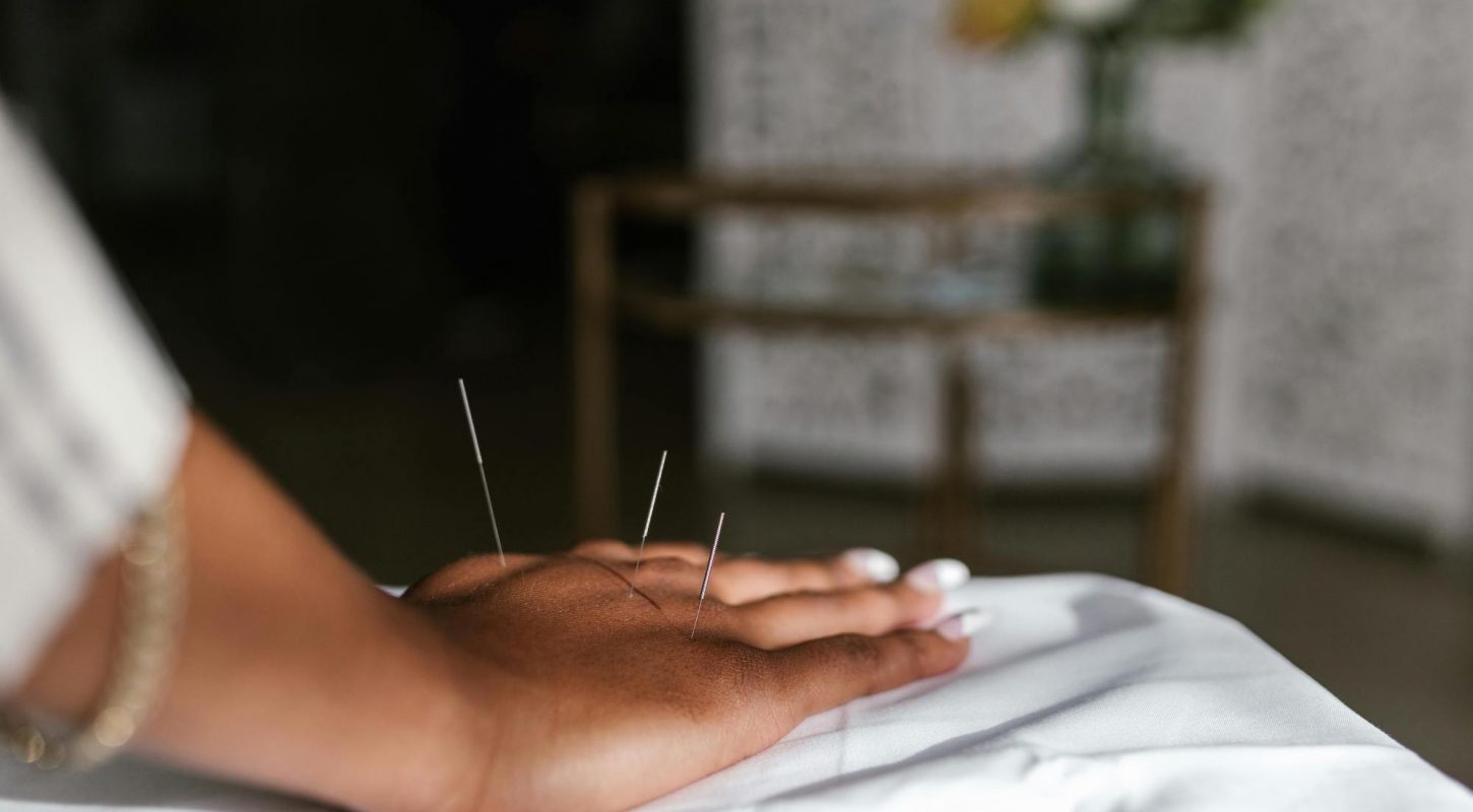 Acupuncture on a hand.